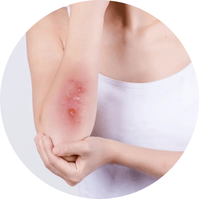 糖尿病導致傷口難癒合