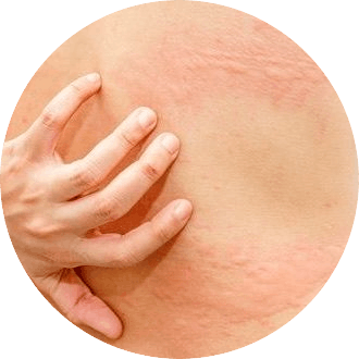 血糖高導致皮膚痕癢