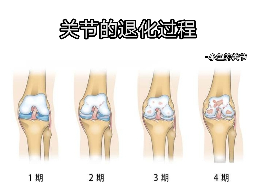关节软骨磨损与退化四个阶段