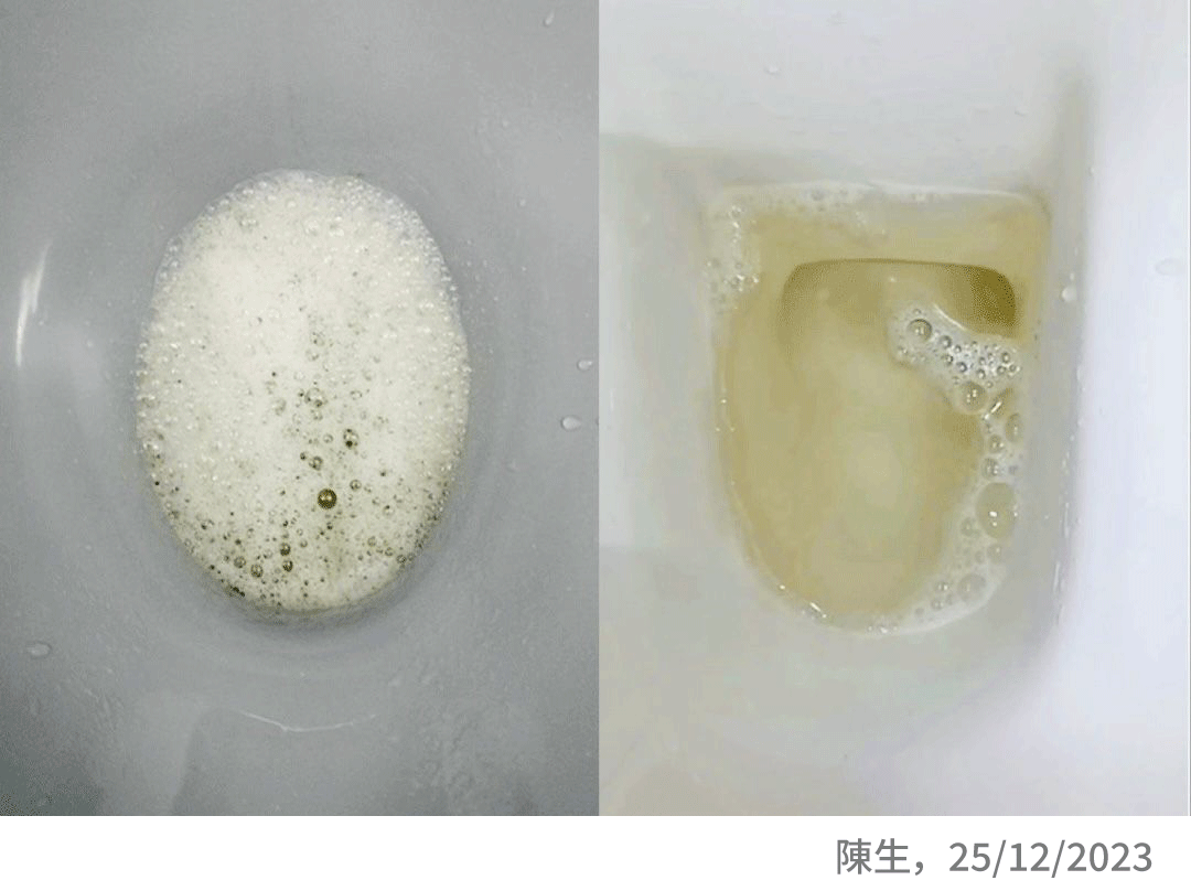 尿液改善對比圖