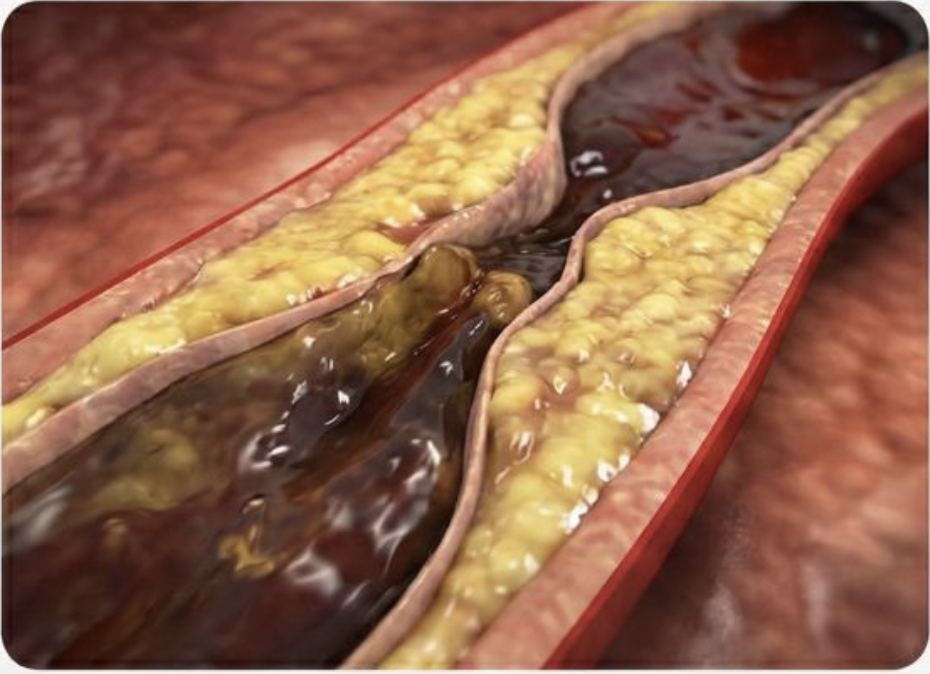 一般三高人士血管狀態