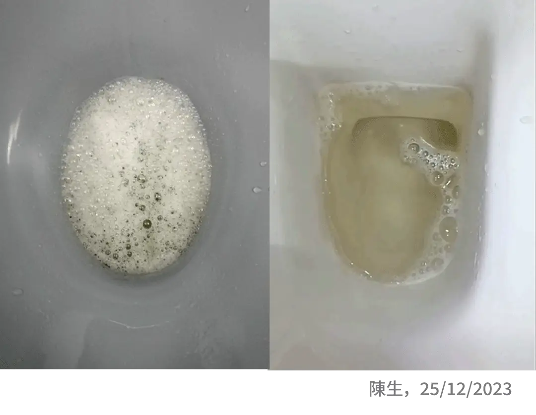 泡泡尿改善對比圖——服用前後真實對比