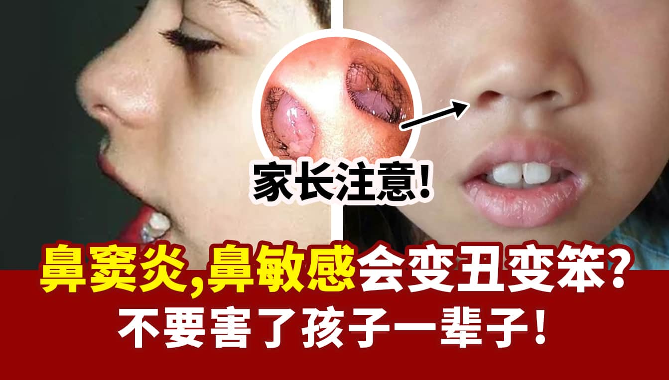 鼻窦炎，鼻敏感会变丑变笨
