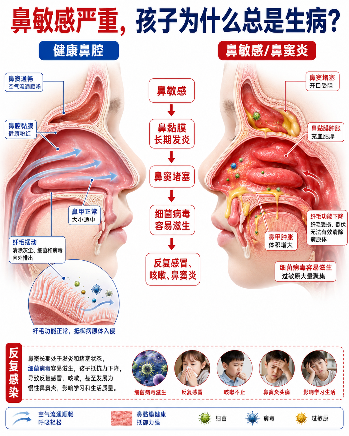 鼻敏感严重，孩子为什么总是生病 - 健康鼻腔对比鼻敏感/鼻窦炎