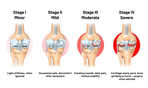 4 Stages of Knee Arthritis