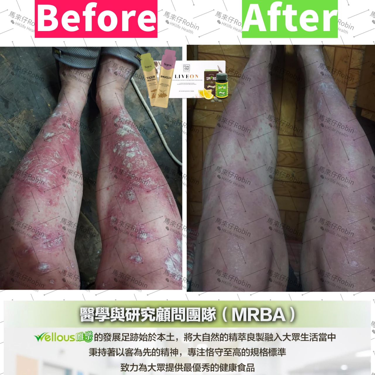 牛皮癬患者使用清調養60日後的真實對比圖